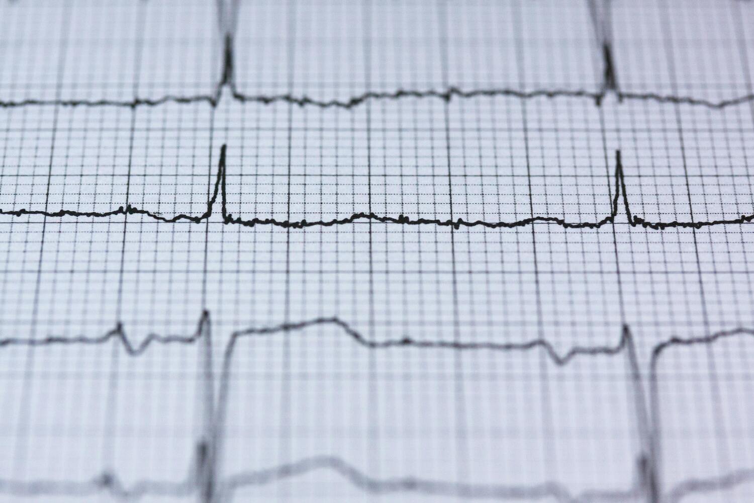 vezeték nélküli EKG